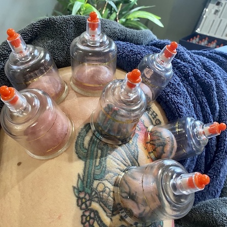 dry cupping treatment at elevate body clinic in chipping norton, oxfordshire