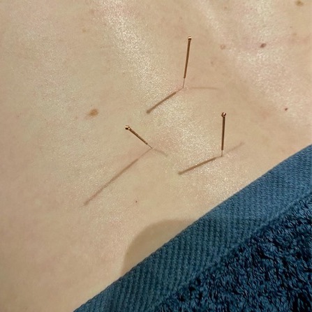 dry needling at elevate body clinic, chipping norton, oxfordshire